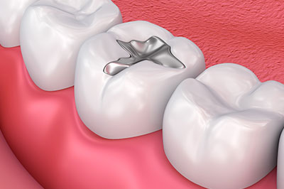 This image features a close-up view of a dental implant, which is a small, metallic screw-like structure inserted into the jawbone to replace a missing tooth.