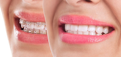 The image shows a close-up of a person s face with a focus on their teeth, which are prominently displayed.