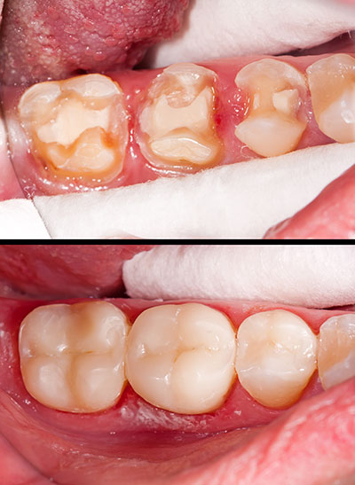 The image shows a close-up of an open mouth with teeth, some of which appear damaged or decayed.