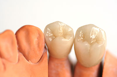 Two artificial teeth with a clear, smooth finish, placed side by side against a white background.