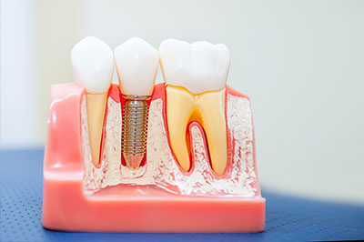 A close-up of a dental model with artificial teeth, one of which has an exposed root and is held in place by a screw, showcasing dental implant technology.
