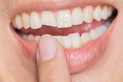 The image shows a close-up of a person s mouth, with the teeth appearing white and well-maintained.