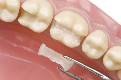 A dental implant being inserted into a prepared tooth socket.