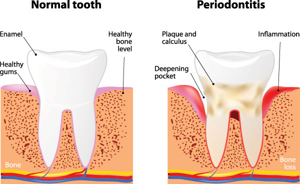 The image is a scientific illustration showing the progression of periodontitis from normal to severe stages, with labels indicating the different levels of inflammation and damage within the gum tissue.