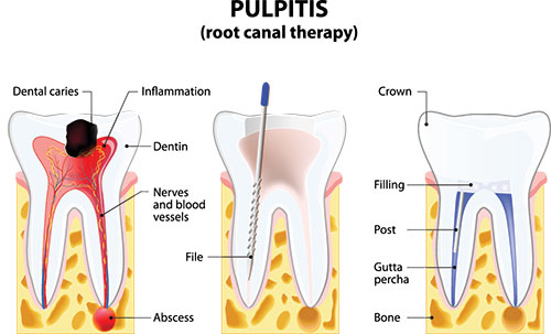 The image is an educational diagram illustrating the process of pulpitis, a dental condition where the pulp in a tooth becomes inflamed. It shows a cross-section of a tooth with labeled parts such as the crown, dentin, nerves, and pulp chamber, along with annotations explaining the stages of pulpitis including initial symptoms like sensitivity to hot or cold liquids, pain, and swelling, and the progression of the condition if left untreated.