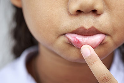 The image shows a young child with a visible pimple on their face, touching the affected area.