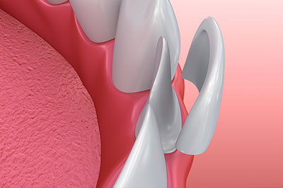 The image shows a close-up view of a dental implant with a visible screw and surrounding pink gum tissue.