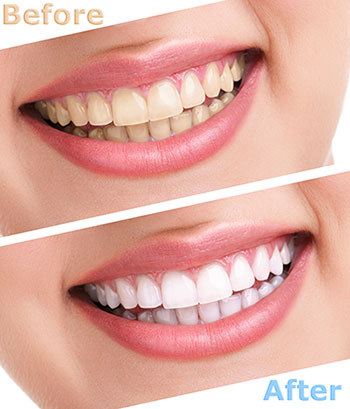 The image shows a side-by-side comparison of a person s teeth before and after dental treatment, highlighting the transformation achieved through teeth whitening.