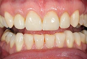 A close-up of a person s teeth with visible stains and discoloration, showing the upper front teeth.