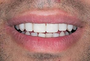 The image features a close-up of a person s smiling face with teeth, showcasing a wide smile and a clean mouth.