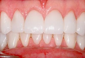 The image displays a close-up of a person s teeth, showcasing a bright smile with white teeth and pink gums.