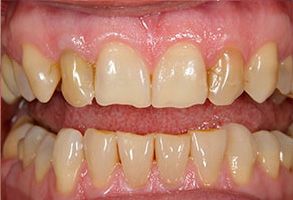 The image shows a close-up of a person s teeth with yellowing and staining, which suggests dental neglect or poor oral hygiene.