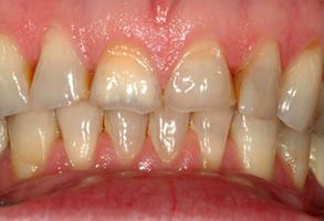 The image shows a close-up of a person s teeth with visible staining and wear, likely for dental health or cosmetic purposes.