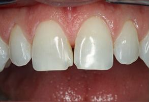 The image shows a close-up of a person s teeth with visible plaque and stains, emphasizing oral hygiene concerns.